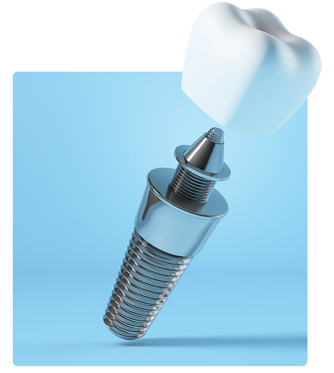 A visual of a patient’s gum healing after dental implant surgery, with proper care and aftercare instructions provided.