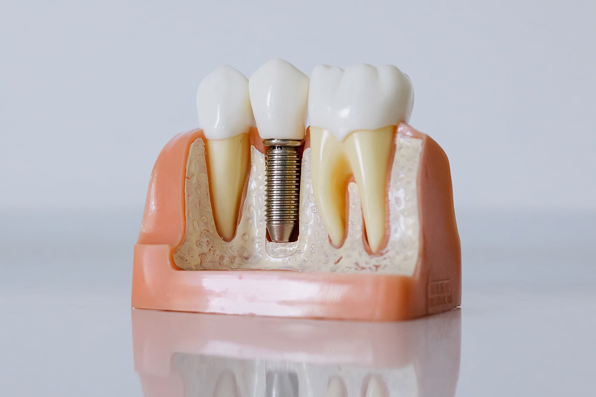 A close-up image showing a dental implant post being inserted into the jawbone, preparing for a natural tooth replacement