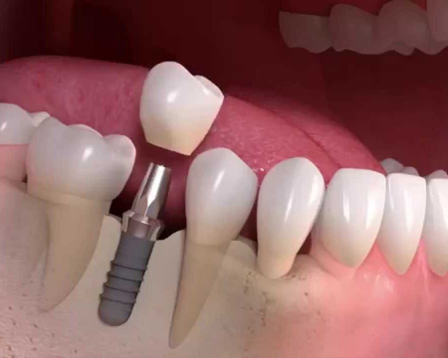 A patient smiling confidently after receiving dental implants, showcasing the natural look and feel of the restored teeth.