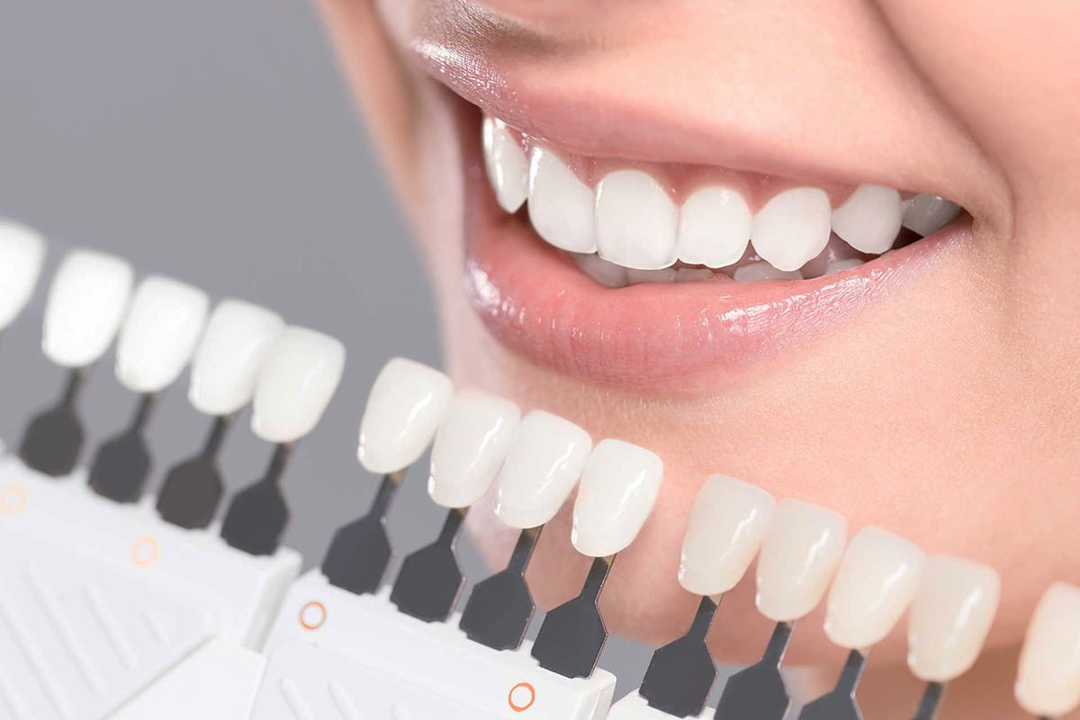 A close-up view of a dental veneer applied to a tooth, enhancing its appearance with a smooth, natural finish.