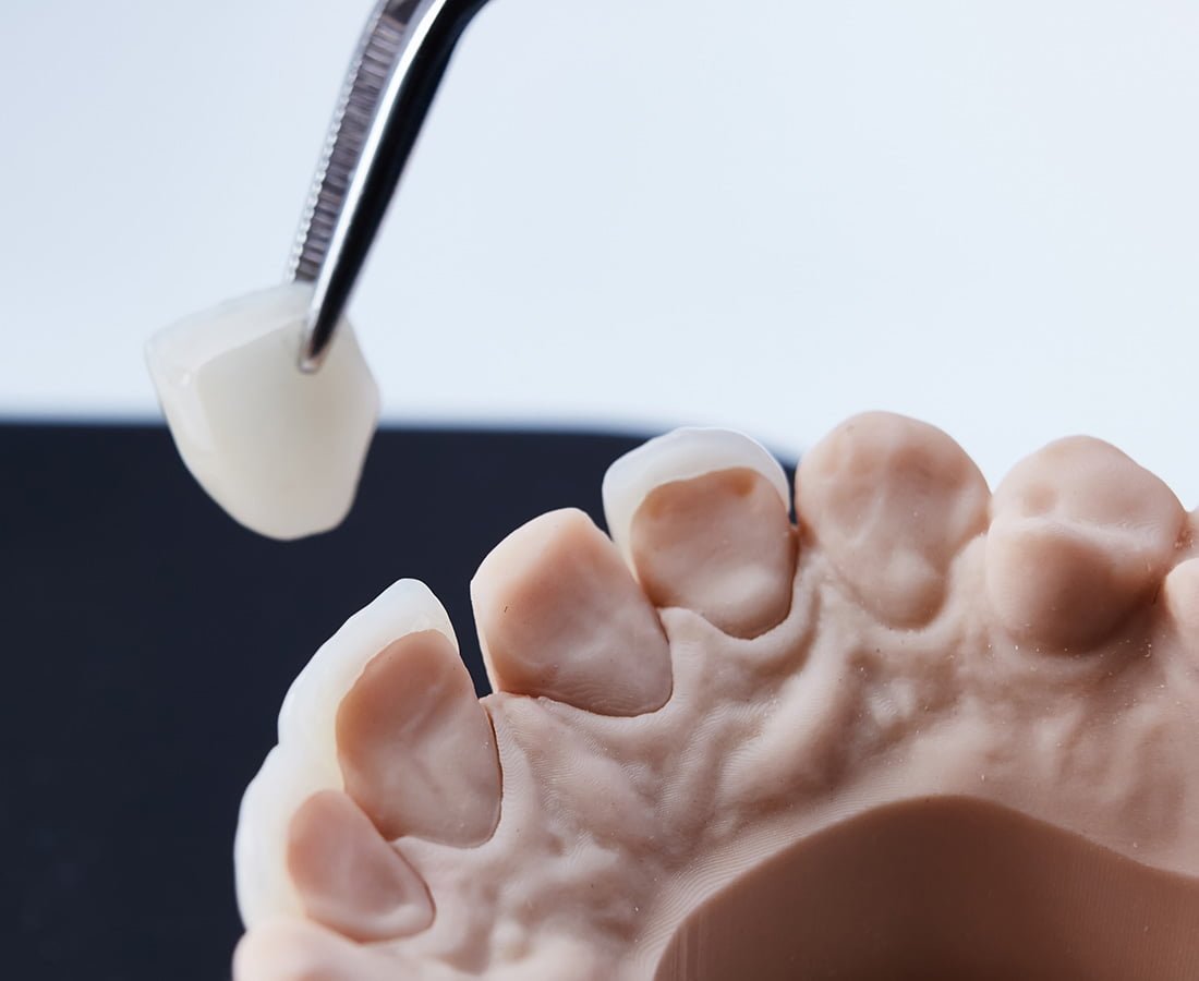 A display of various types of dental veneers, including porcelain and composite options.