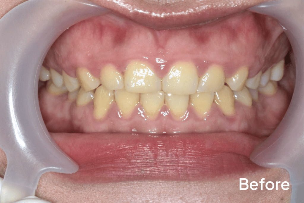 Close-up of a patient's teeth before veneers treatment