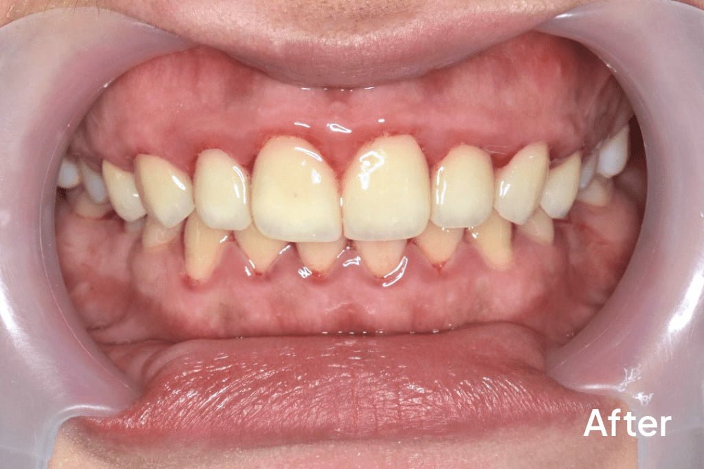 Temporary veneers in place before the final porcelain veneers are applied.