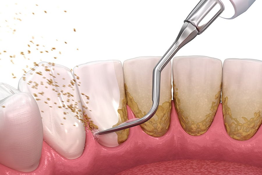 A dentist performing a dental scaling procedure to remove plaque and tartar buildup from a patient's teeth.