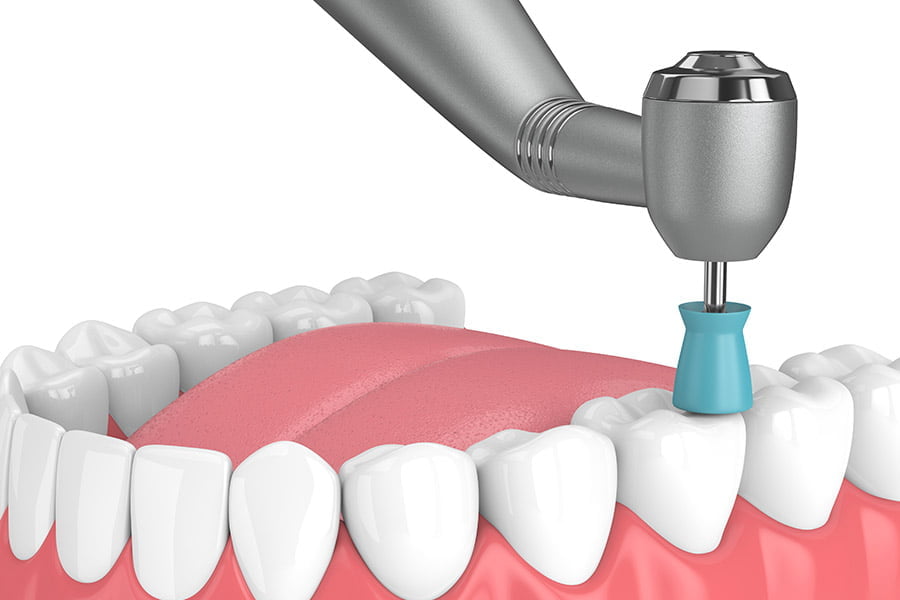 A dentist polishing a patient's teeth after a scaling procedure, leaving them smooth and shiny.