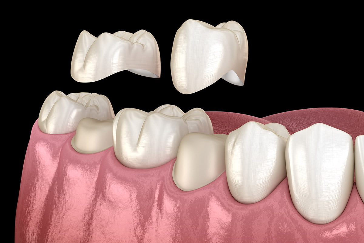 A close-up of a tooth restored with a natural-looking dental crown.
