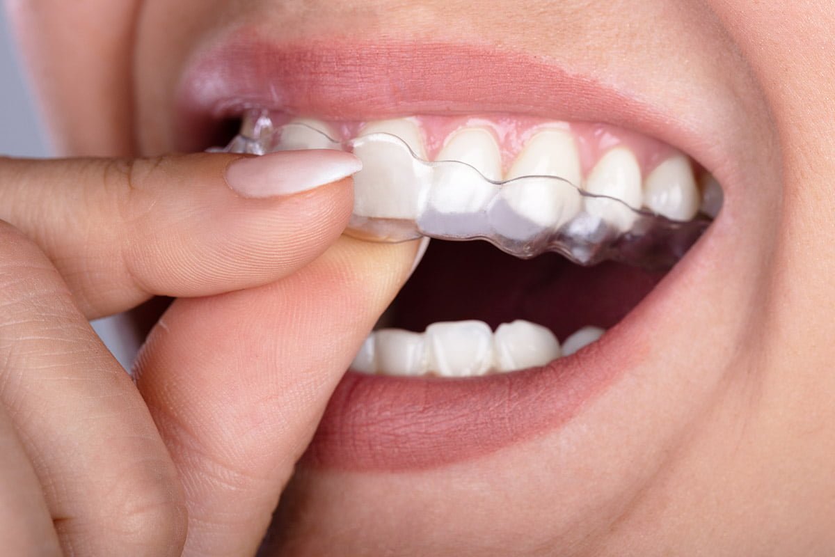 A person holding a pair of Invisalign clear aligners, showcasing their lightweight and transparent design.