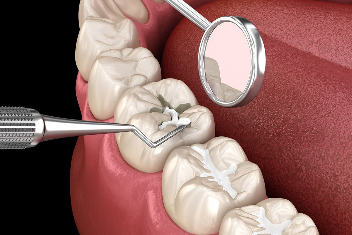 Filling the area between the cusps using ceramic materials