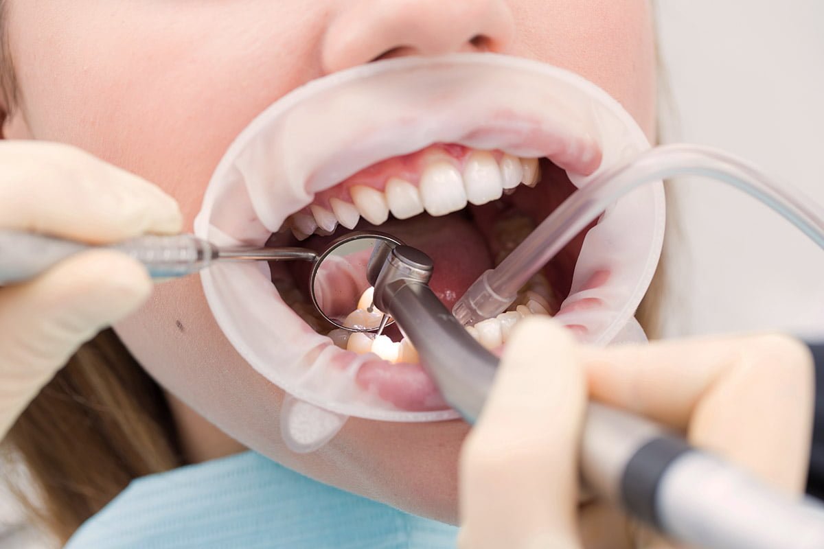 A patient sitting comfortably while receiving a professional scaling and polishing treatment at the dental office.