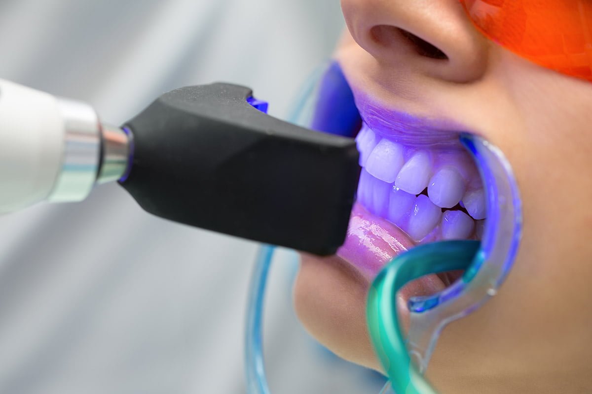 A selection of professional-grade teeth whitening products on a dental clinic counter.