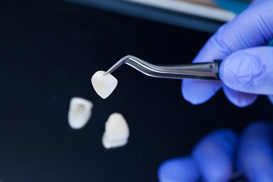 A bright, even smile enhanced with custom-made dental veneers.