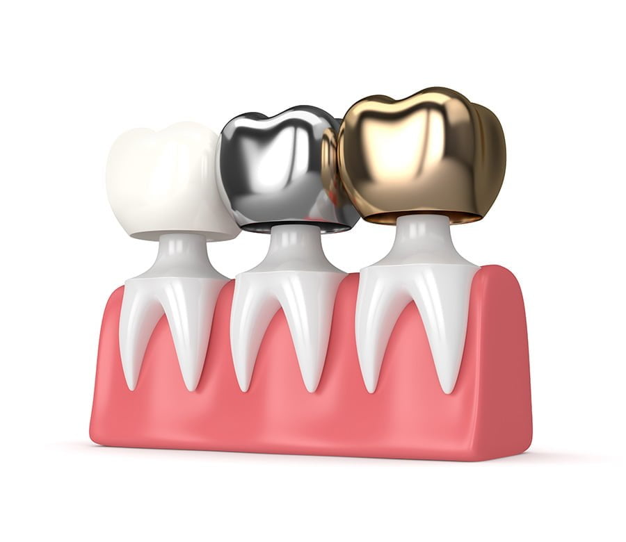 dental crown example