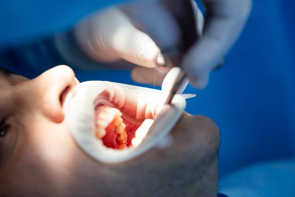 pacient-dental-clinic-while-operation A close-up image of the extraction site after a wisdom tooth has been removed, showing the healing process.