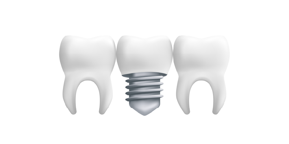 How Dental Implants Restore Confidence and Function to Your Smile A close-up image of a titanium dental implant post inserted into the jawbone, prepared for the placement of a crown.