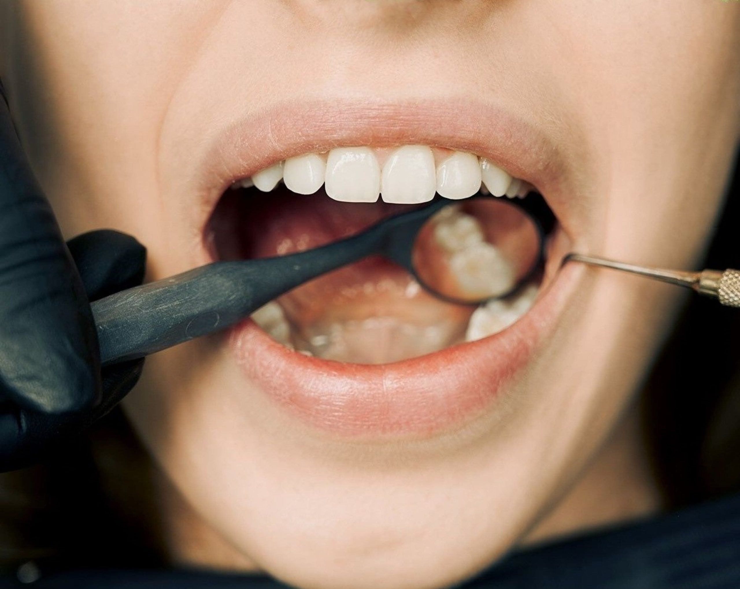 pexels-arvind-philomin-12148417 A dentist carefully performing a wisdom tooth extraction on a patient.
